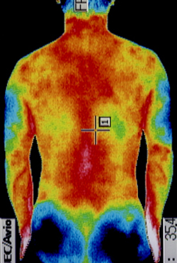 野球の腰痛の原因｜筋力低下や背中の温度分布（治療後）