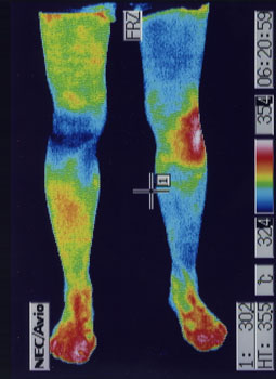 ランナー膝の原因｜左右の筋力低下や関節炎の温度分布（治療後）