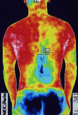 背骨のゆがみの原因｜筋力低下や背中の温度分布（治療前）