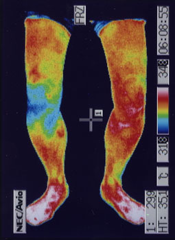 ベーカー嚢腫の原因｜左右の筋力低下や関節炎の温度分布（治療前）