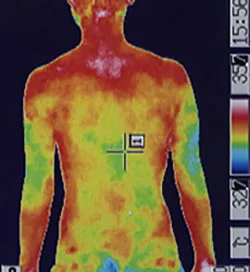 ギラン・バレー症候群｜背中の体温分布（治療後）