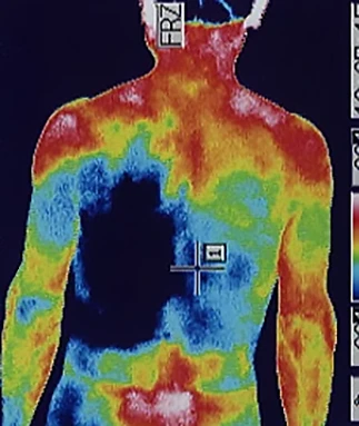 突発性難聴後遺症｜免疫力低下を調べるサーモグラフィの検査