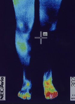 足根洞症候群｜筋肉の代謝異常を調べます。