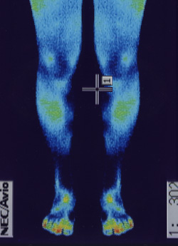 特発性側湾症の原因｜筋力低下や背中の温度分布（治療後）