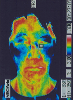 パーキンソン病｜自律神経異常｜顔の温度分布（治療前）