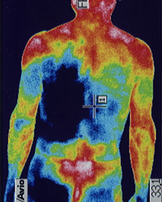 十二指腸潰瘍の原因となるストレスを調べるサーモグラフィーの検査
