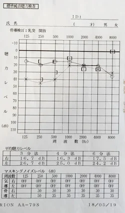 突発性難聴で埼玉県から通院されたJ.S.様の治療前のオージオグラム