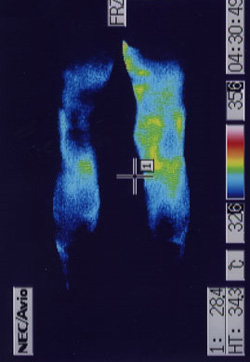前立腺癌手術後遺症症 | 足のサーモ画像
