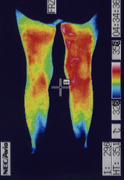 膝の水が溜まる原因｜左右の筋力低下や関節炎の温度分布（治療後）