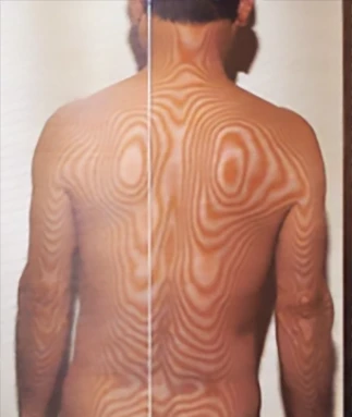 多系統萎縮症|重心のバランスを調べる検査