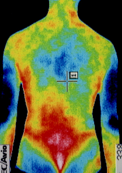 ぎっくり腰の後遺症の原因｜筋力低下や背中の温度分布（治療前）