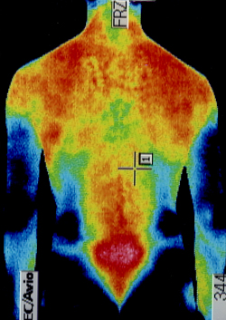 ぎっくり腰の後遺症の原因｜筋力低下や背中の温度分布（治療後）