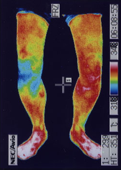 膝の水が溜まる原因｜左右の筋力低下や関節炎の温度分布（治療前）