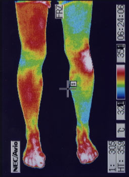 膝蓋骨脱臼の原因｜左右の筋力低下や関節炎の温度分布（治療前）