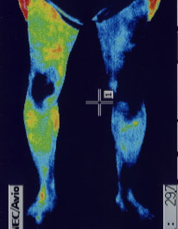 足のしびれの原因｜筋力低下や背中の温度分布（治療前）