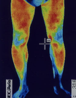 足のしびれの原因｜筋力低下や背中の温度分布（治療後）
