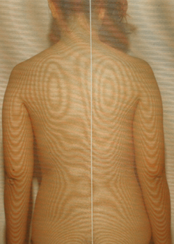腰椎すべり症が原因の背骨の側弯
