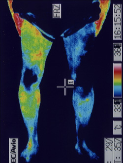 坐骨神経痛の原因｜筋力低下や背中の温度分布（治療前）