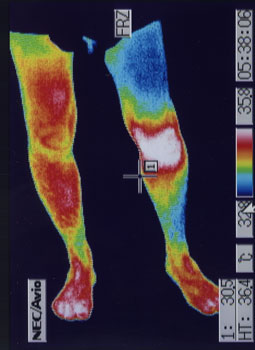 前十字靭帯損傷の原因｜左右の筋力低下や関節炎の温度分布（治療前）