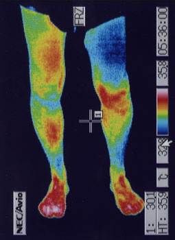 前十字靭帯損傷の原因｜左右の筋力低下や関節炎の温度分布（治療後）