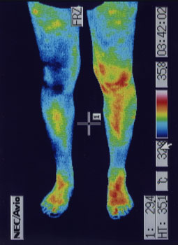 後十字靭帯損傷の原因｜左右の筋力低下や関節炎の温度分布（治療後）