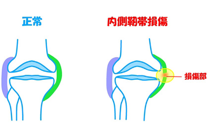 膝の内側側副靭帯