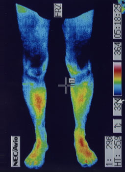 鵞足炎の原因｜左右の筋力低下や関節炎の温度分布（治療後）