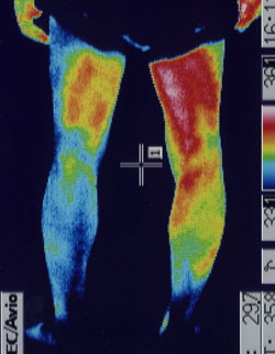 椎間板ヘルニアの坐骨神経痛｜麻痺した足の温度分布（治療前）