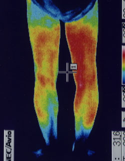 椎間板ヘルニアの坐骨神経痛｜麻痺が治った足の温度分布（治療後）