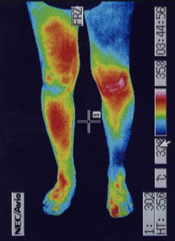 タナ障害の原因｜左右の筋力低下や関節炎の温度分布（治療前）