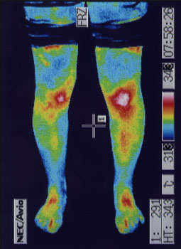 オスグッドシュラッター病の原因｜左右の筋力低下や関節炎の温度分布（治療前）