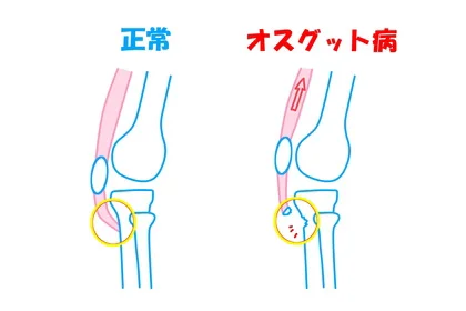 膝の構造とオスグッド・シュラッター病