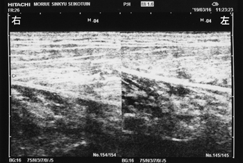 ジャンパー膝の検査｜軟部組織の損傷を調べます。