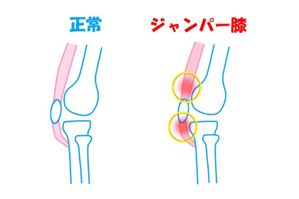 膝の構造とジャンパー膝