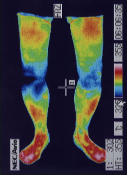特発性骨壊死の原因｜左右の筋力低下や関節炎の温度分布（治療後）