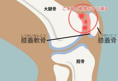 膝の構造と膝蓋軟骨軟化症