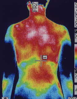 仙腸関節炎の原因｜筋力低下や背中の温度分布（治療前）