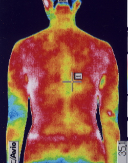 仙腸関節炎の原因｜筋力低下や背中の温度分布（治療後）