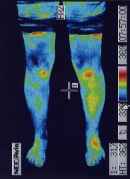 有痛性分離膝蓋骨の原因｜左右の筋力低下や関節炎の温度分布（治療後）
