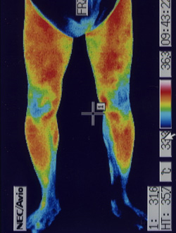 腓骨神経麻痺の原因｜筋力低下や背中の温度分布（治療後）