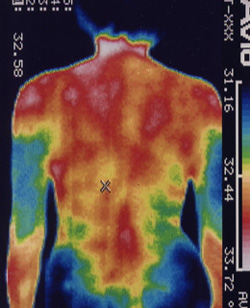 腓骨神経麻痺の原因｜筋力低下や背中の温度分布（治療後）