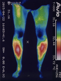 特発性側湾症の原因｜筋力低下や背中の温度分布（治療前）