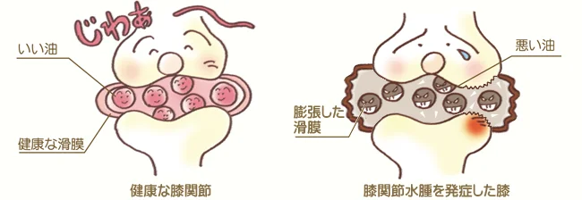 グロインペイン症候群の鍼治療