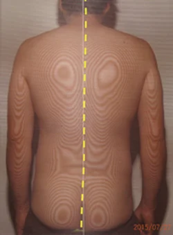 痙性斜頸の原因|体の重心バランスの傾き(治療後)