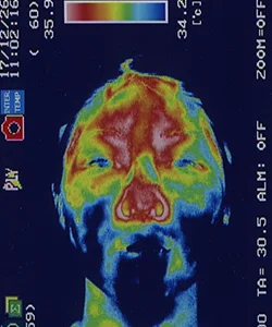 顔面神経麻痺｜下あごの血流（治療前）
