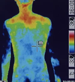 ギラン・バレー症候群｜背中の体温分布（治療前）