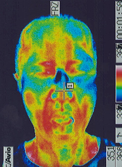 コロナ後遺症の原因｜自律神経異常｜顔の温度分布（治療後）