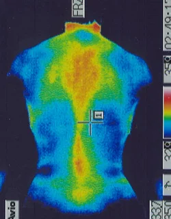 コロナ後遺症｜背部の温度分布（治療前）