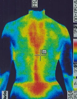 コロナ後遺症｜背部の温度分布（治療後）