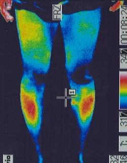 コロナ後遺症｜脚の温度分布（治療後）